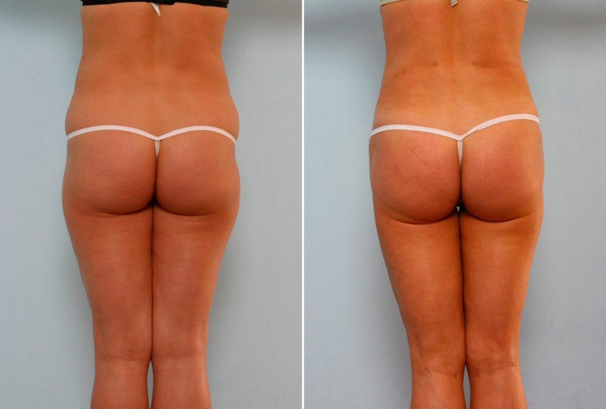 Abdominoplasty Before & After Gallery - Patient 54867081 - Image 6