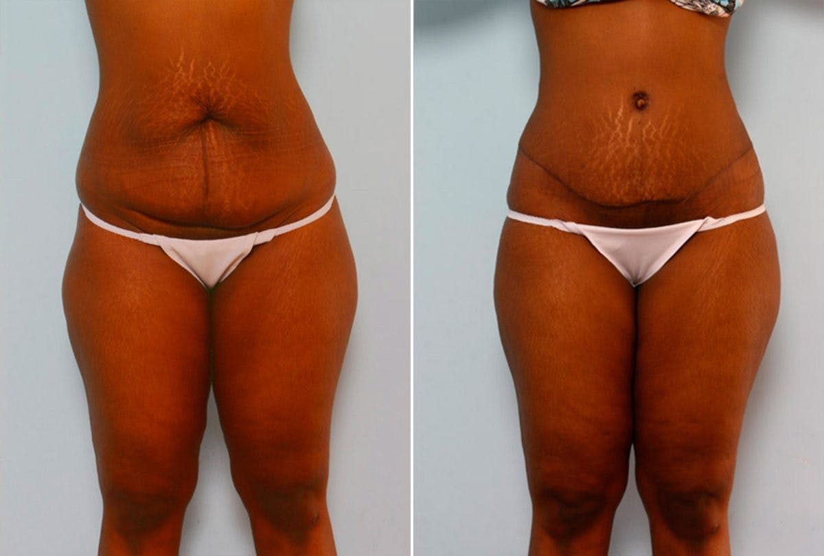 Abdominoplasty Before & After Photo - Patient 54867085 - Image 1