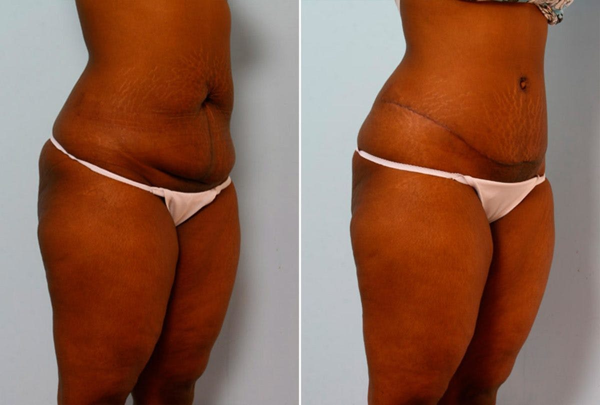 Abdominoplasty Before & After Gallery - Patient 54867085 - Image 2