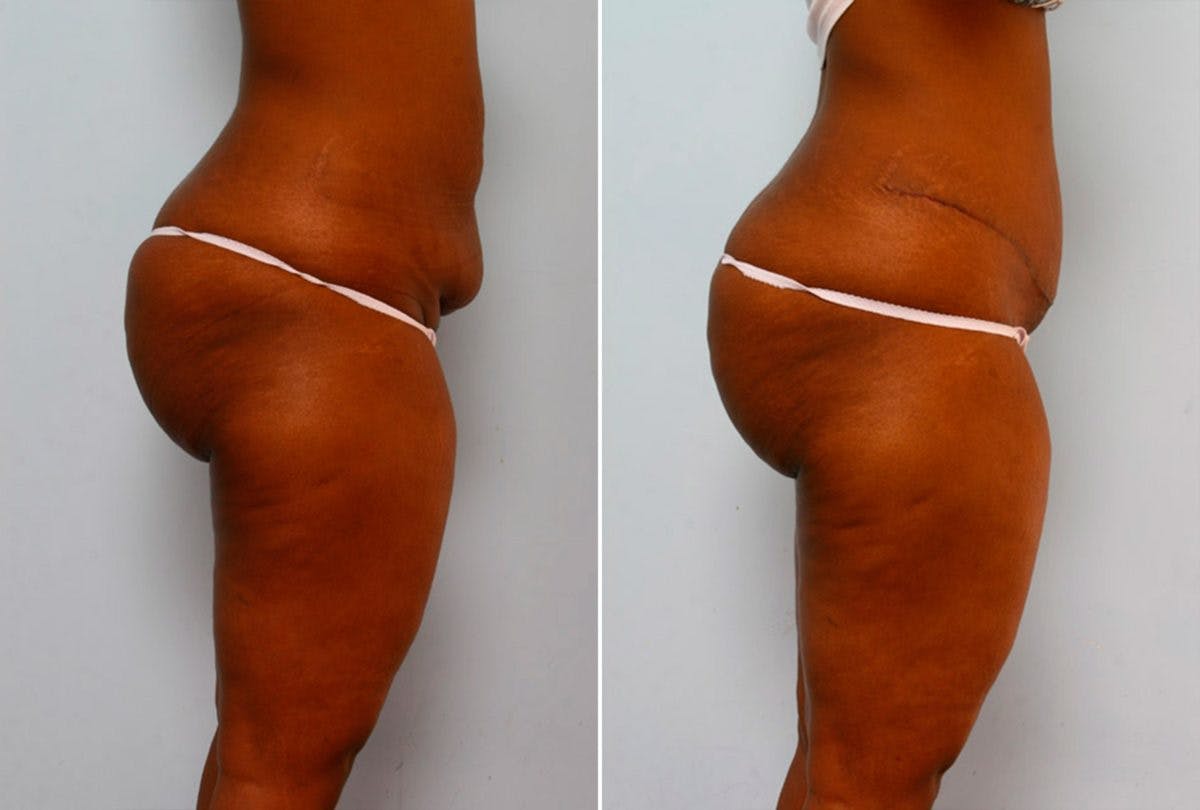 Abdominoplasty Before & After Gallery - Patient 54867085 - Image 3