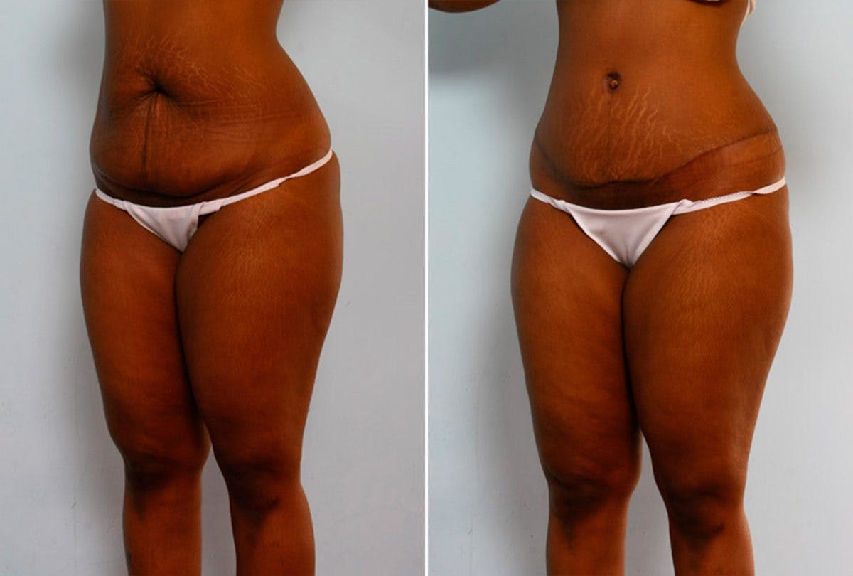 Abdominoplasty Before & After Photo - Patient 54867085 - Image 4