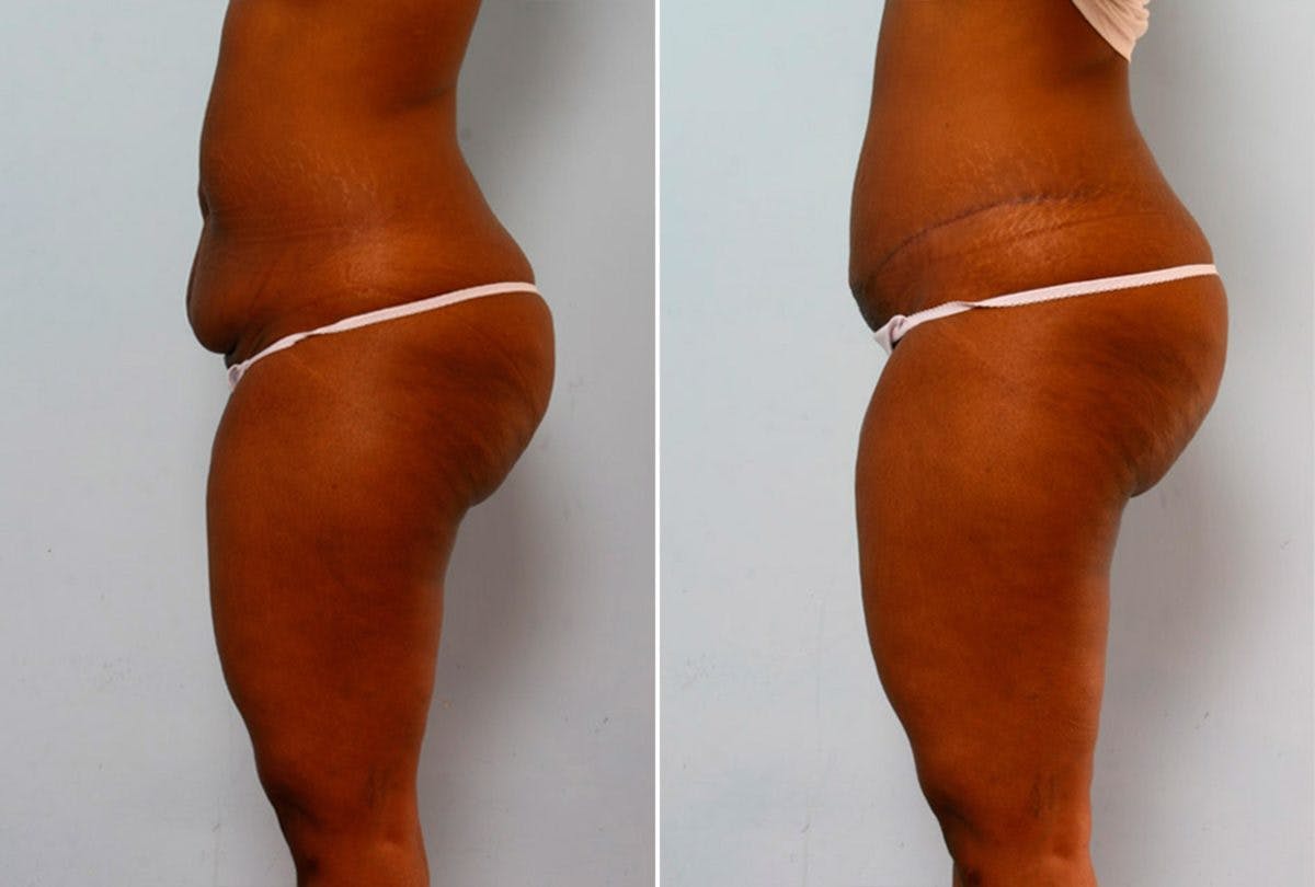 Abdominoplasty Before & After Gallery - Patient 54867085 - Image 5