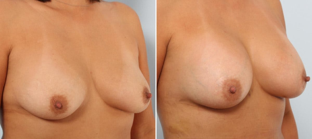 Mommy Makeover Before & After Gallery - Patient 54867086 - Image 4