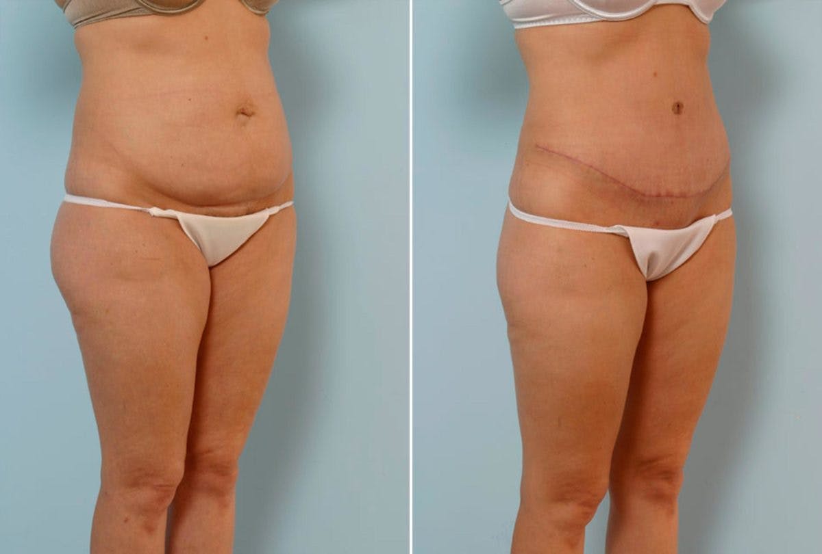 Abdominoplasty Before & After Gallery - Patient 54867837 - Image 2
