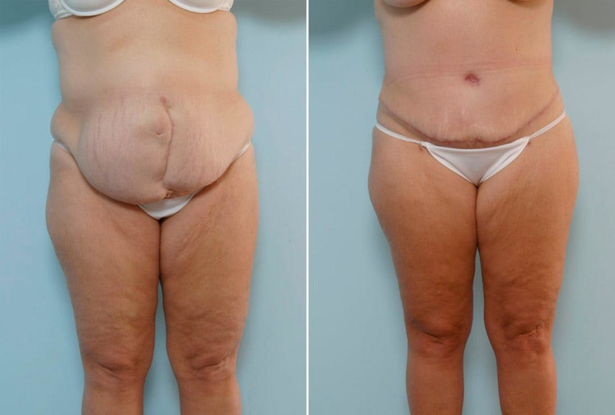 Abdominoplasty Before & After Gallery - Patient 54867839 - Image 1
