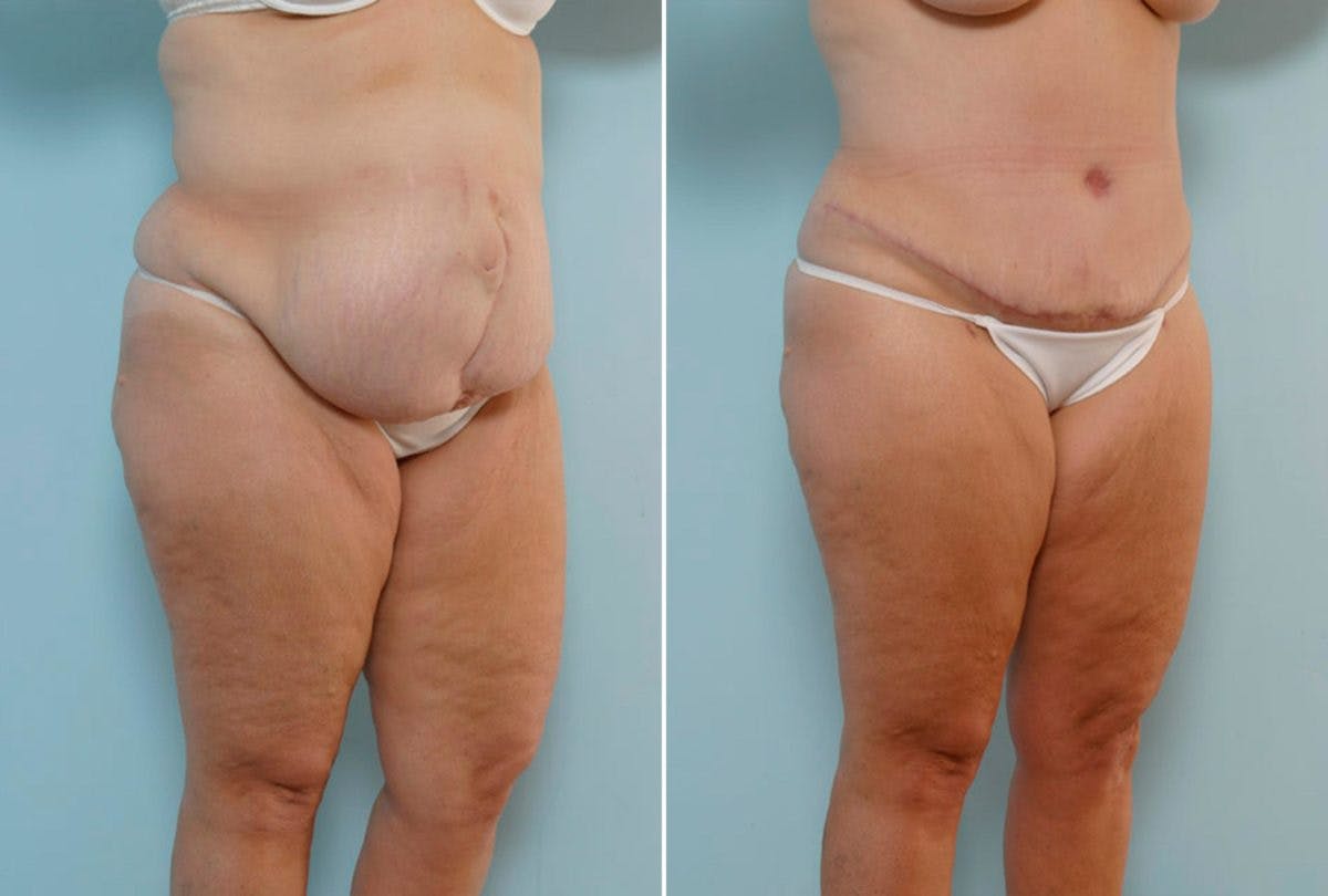 Abdominoplasty Before & After Gallery - Patient 54867839 - Image 2
