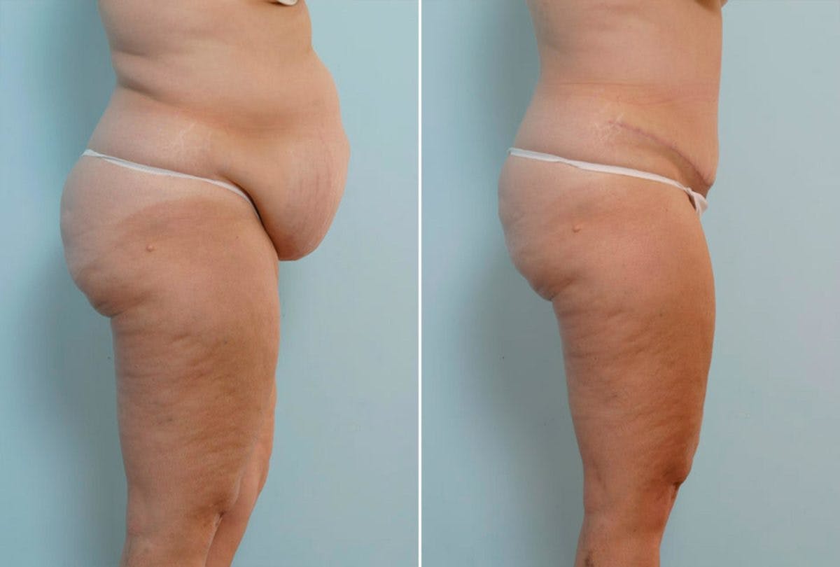 Abdominoplasty Before & After Gallery - Patient 54867839 - Image 3
