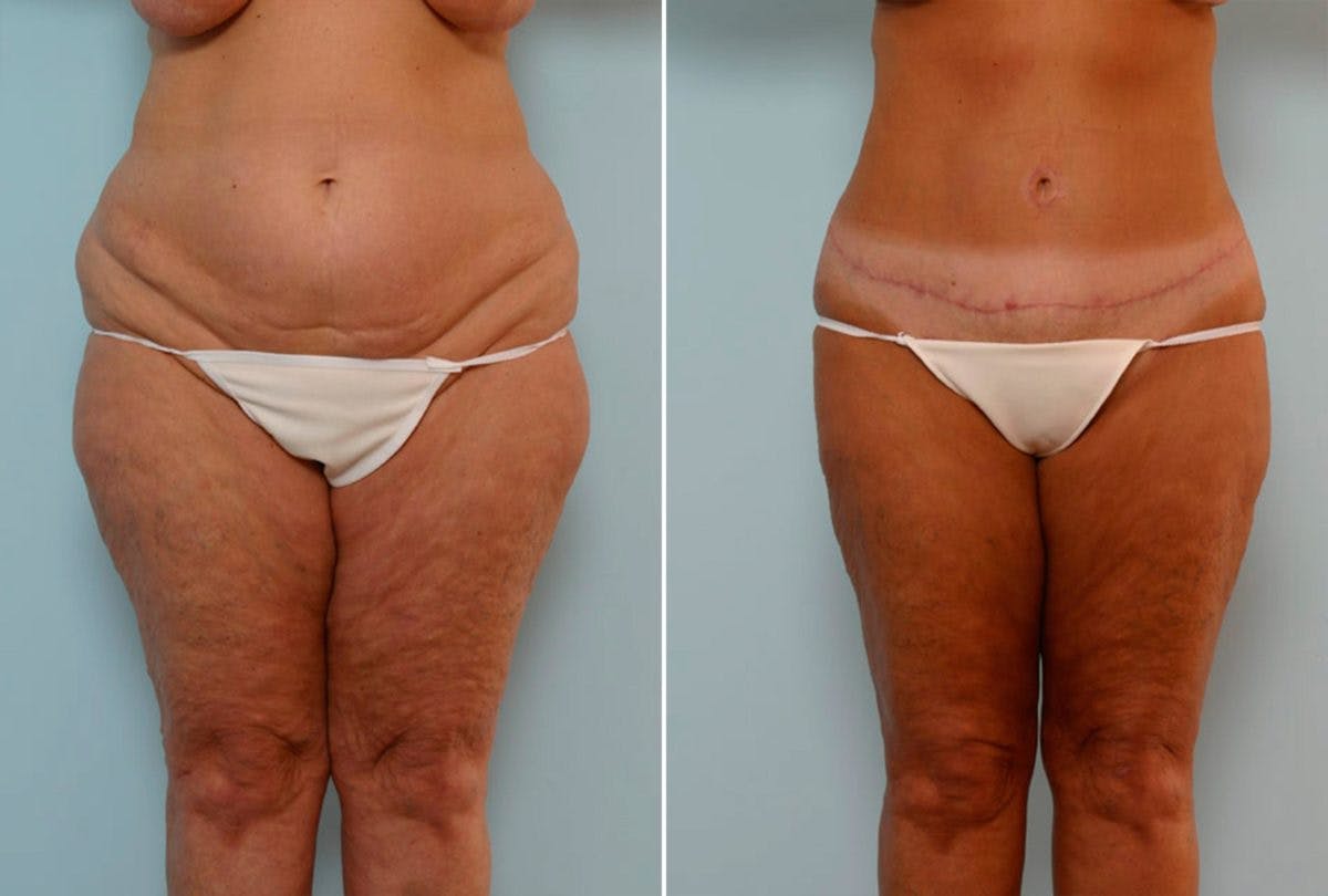 Abdominoplasty Before & After Gallery - Patient 54867844 - Image 1
