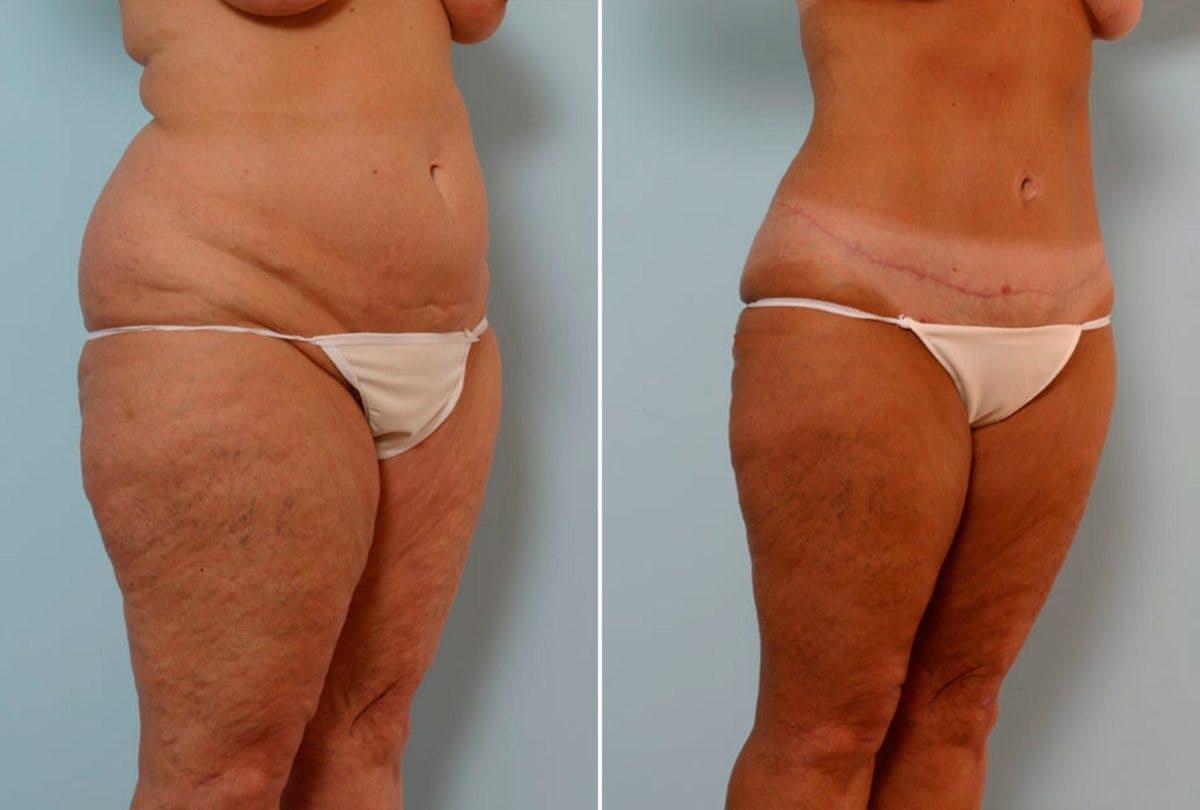 Abdominoplasty Before & After Gallery - Patient 54867844 - Image 2