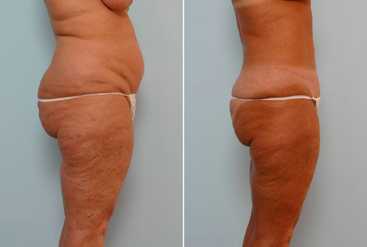 Abdominoplasty Before & After Gallery - Patient 54867844 - Image 3