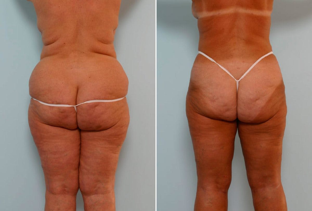 Abdominoplasty Before & After Gallery - Patient 54867844 - Image 4