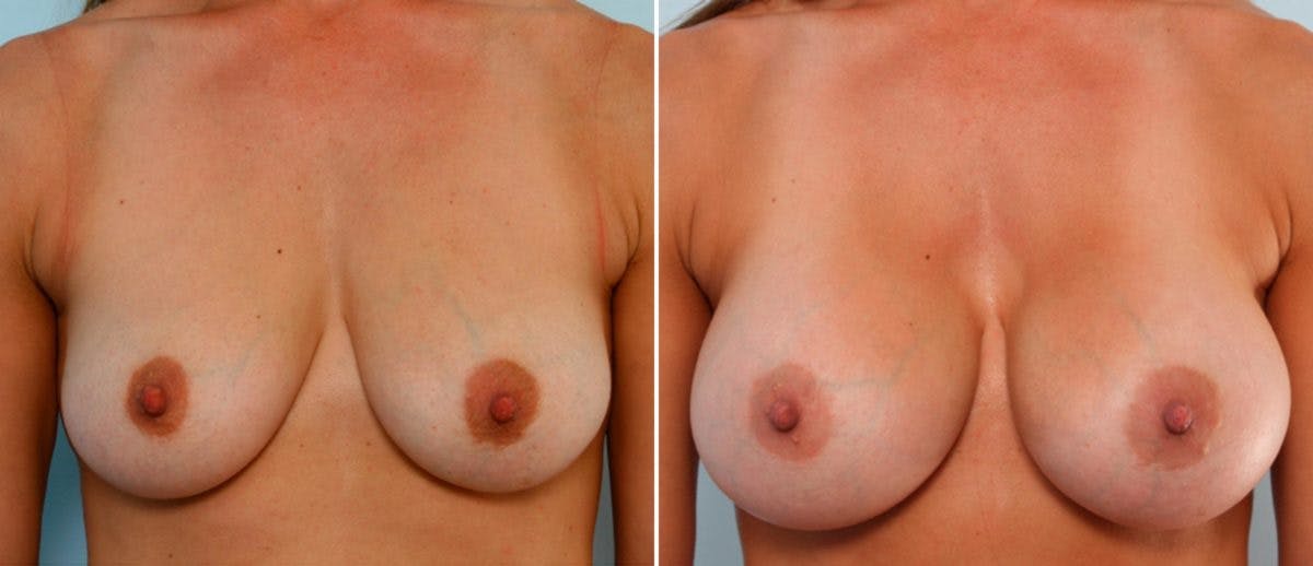 Mommy Makeover Before & After Gallery - Patient 54867845 - Image 1