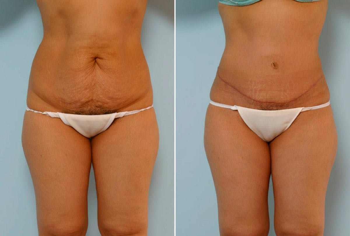 Abdominoplasty Before & After Gallery - Patient 54867847 - Image 1