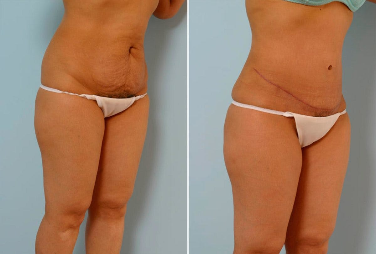 Abdominoplasty Before & After Gallery - Patient 54867847 - Image 2