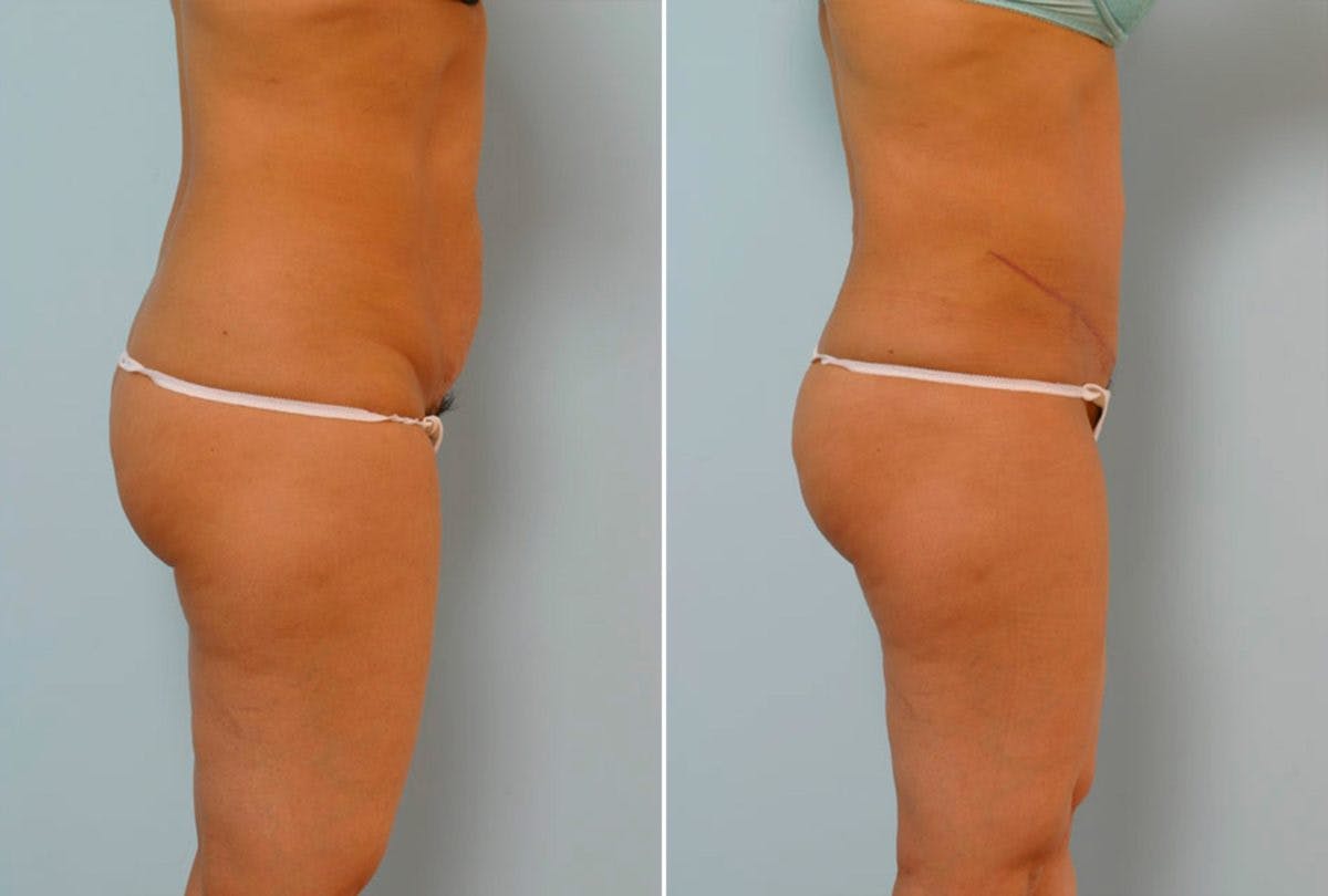 Abdominoplasty Before & After Gallery - Patient 54867847 - Image 3