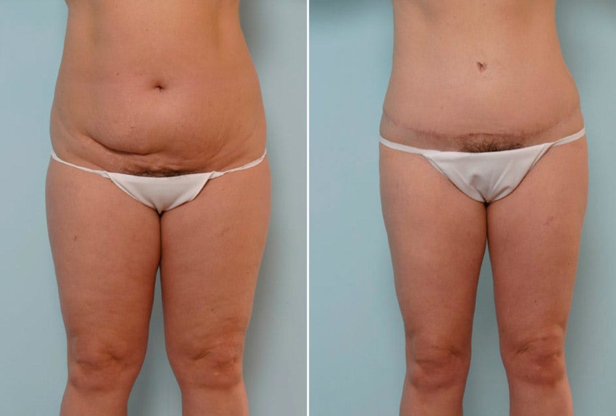 Abdominoplasty Before & After Gallery - Patient 54867851 - Image 1