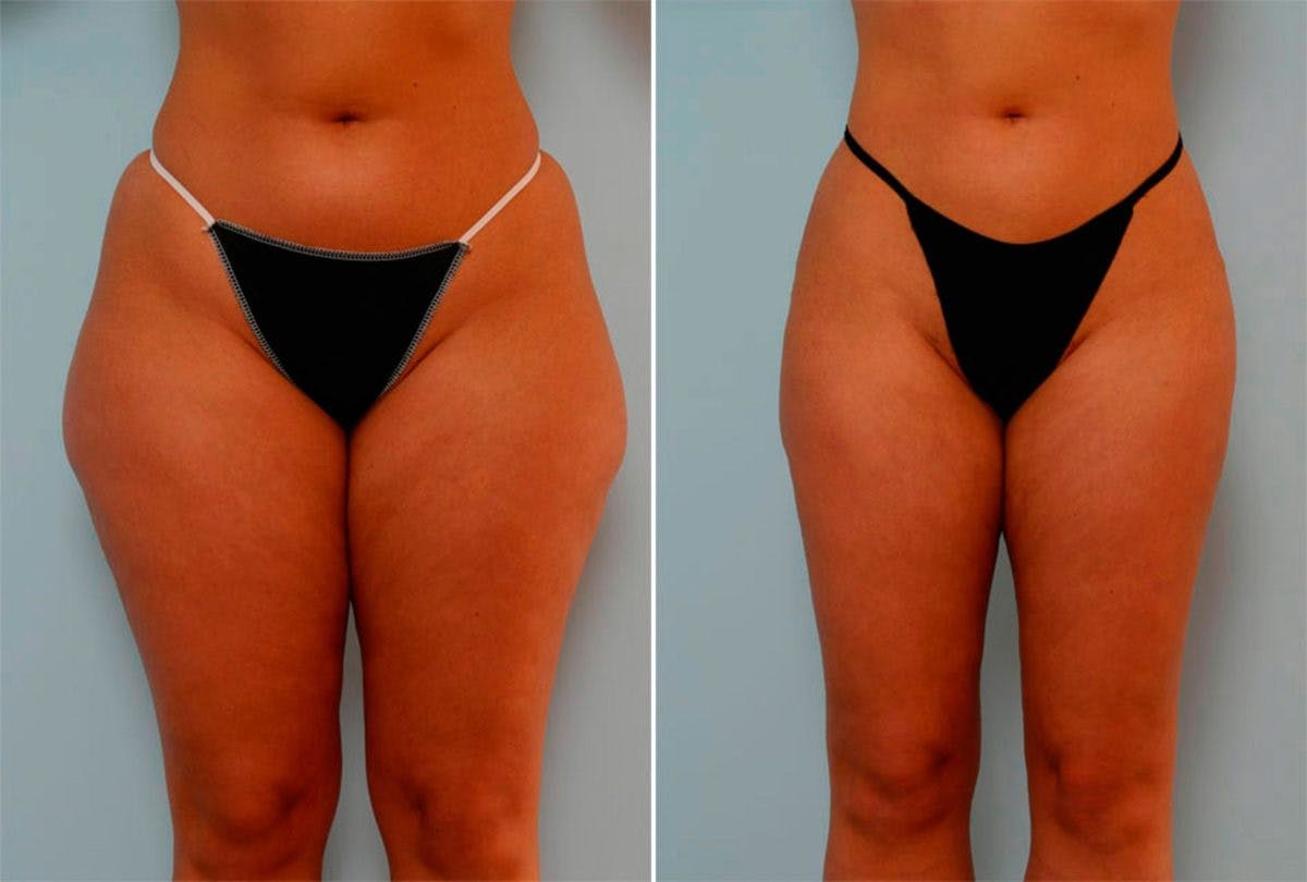 Female Liposuction Before & After Photo - Patient 54867850 - Image 1
