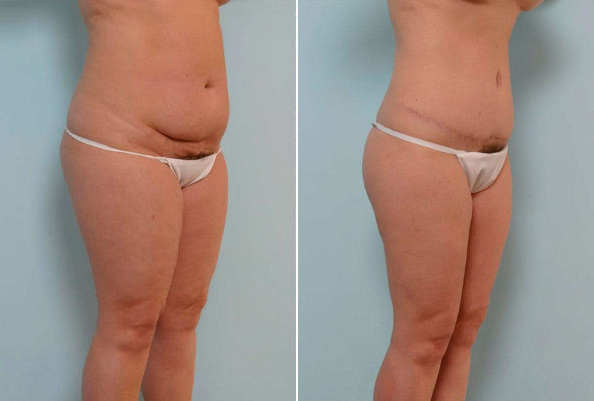 Abdominoplasty Before & After Gallery - Patient 54867851 - Image 2