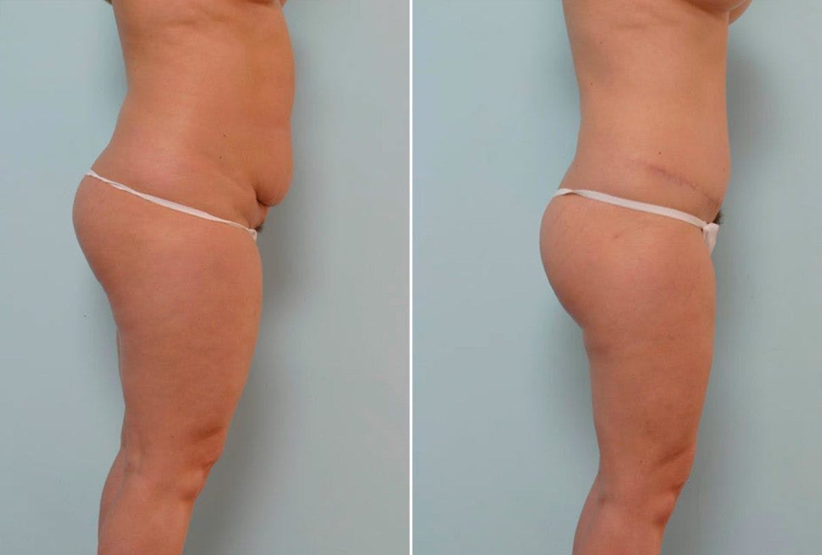 Abdominoplasty Before & After Gallery - Patient 54867851 - Image 3