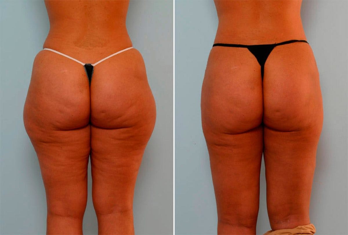 Female Liposuction Before & After Photo - Patient 54867850 - Image 3