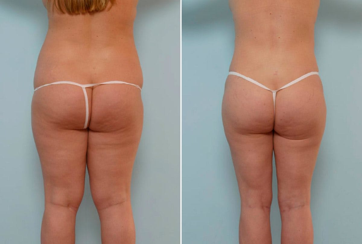 Abdominoplasty Before & After Gallery - Patient 54867851 - Image 4