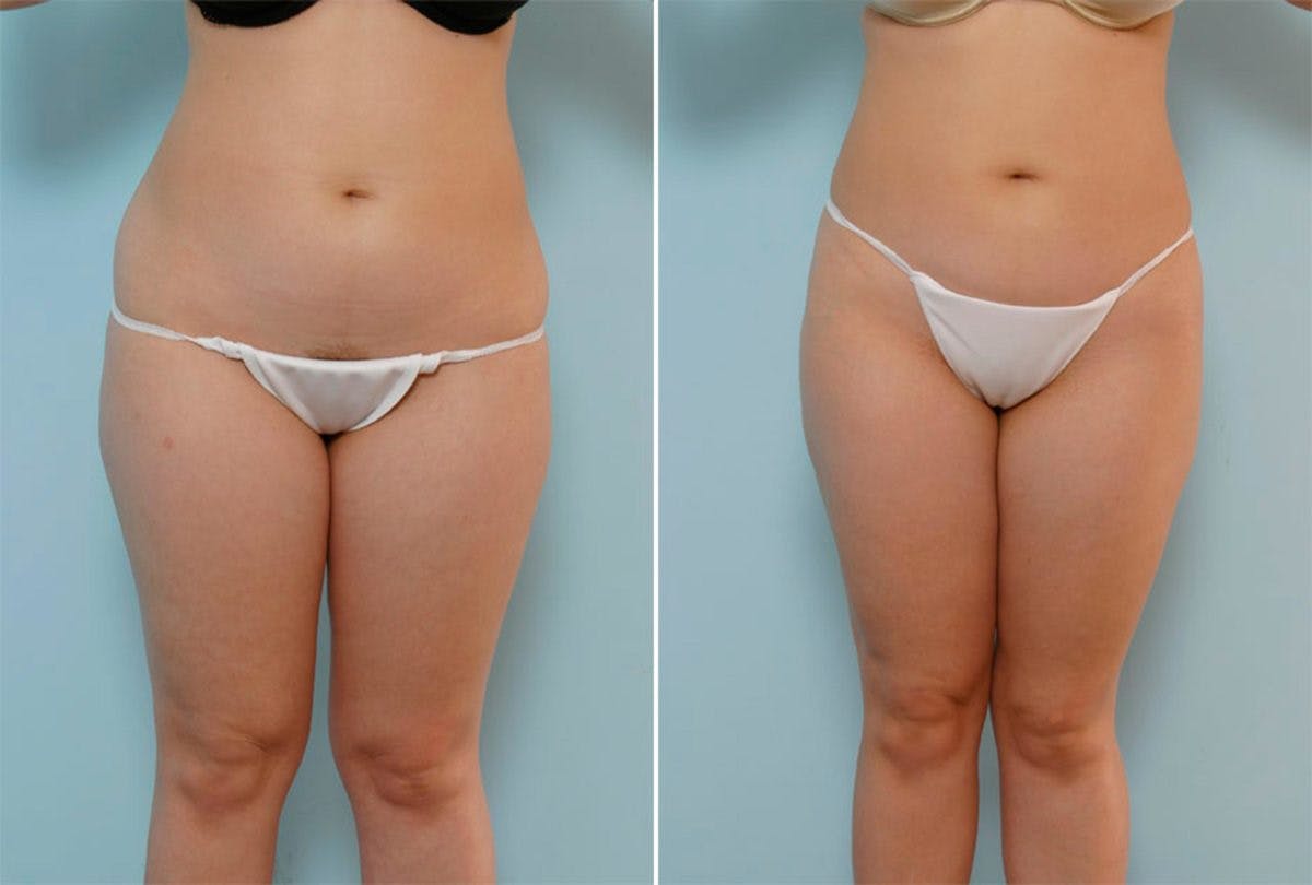 Female Liposuction Before & After Photo - Patient 54867853 - Image 1