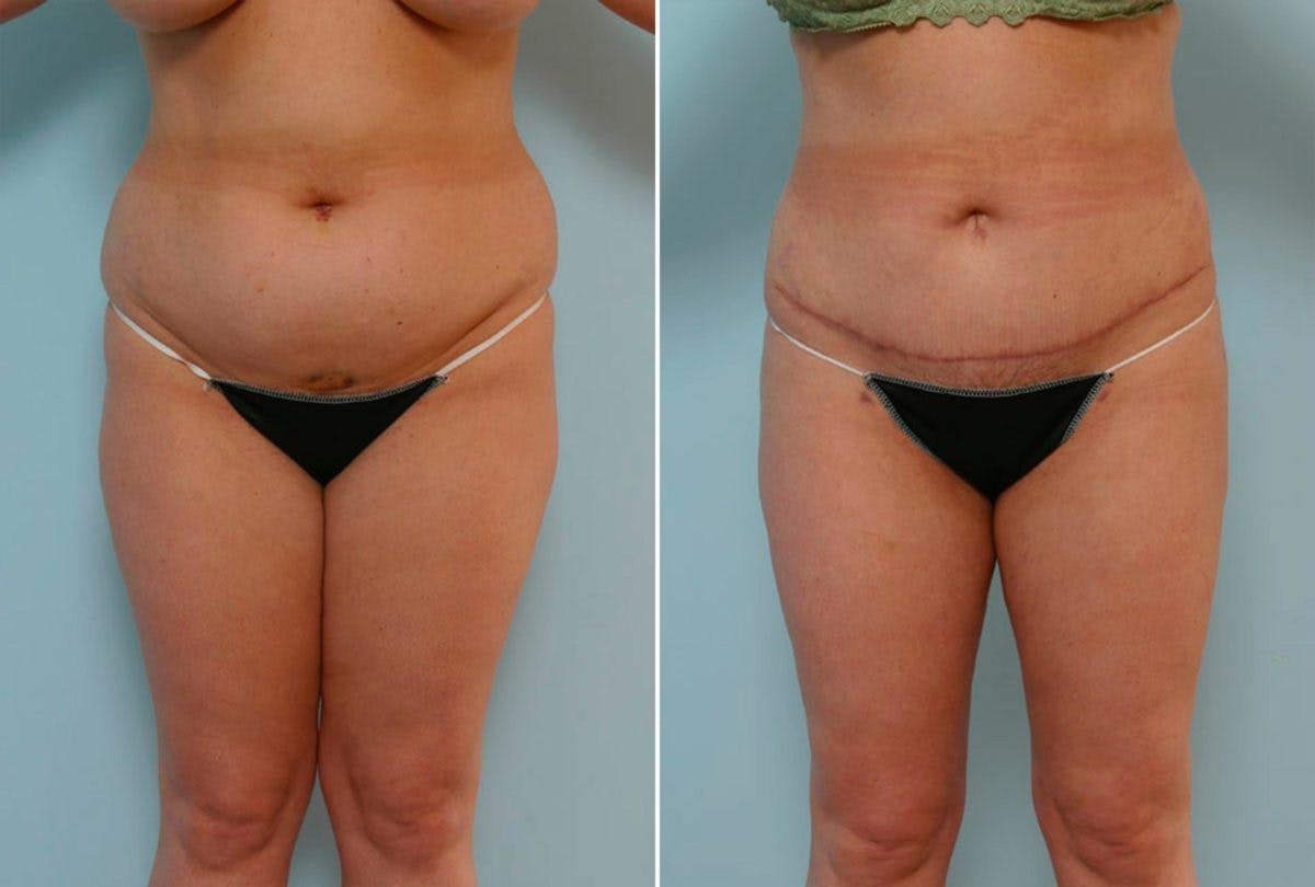 Abdominoplasty Before & After Gallery - Patient 54867858 - Image 1
