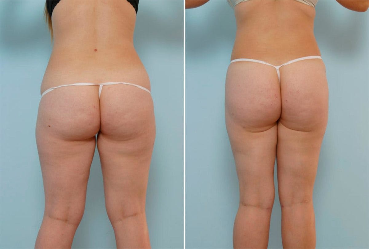 Female Liposuction Before & After Gallery - Patient 54867853 - Image 3