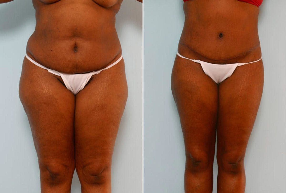 Abdominoplasty Before & After Gallery - Patient 54867861 - Image 1