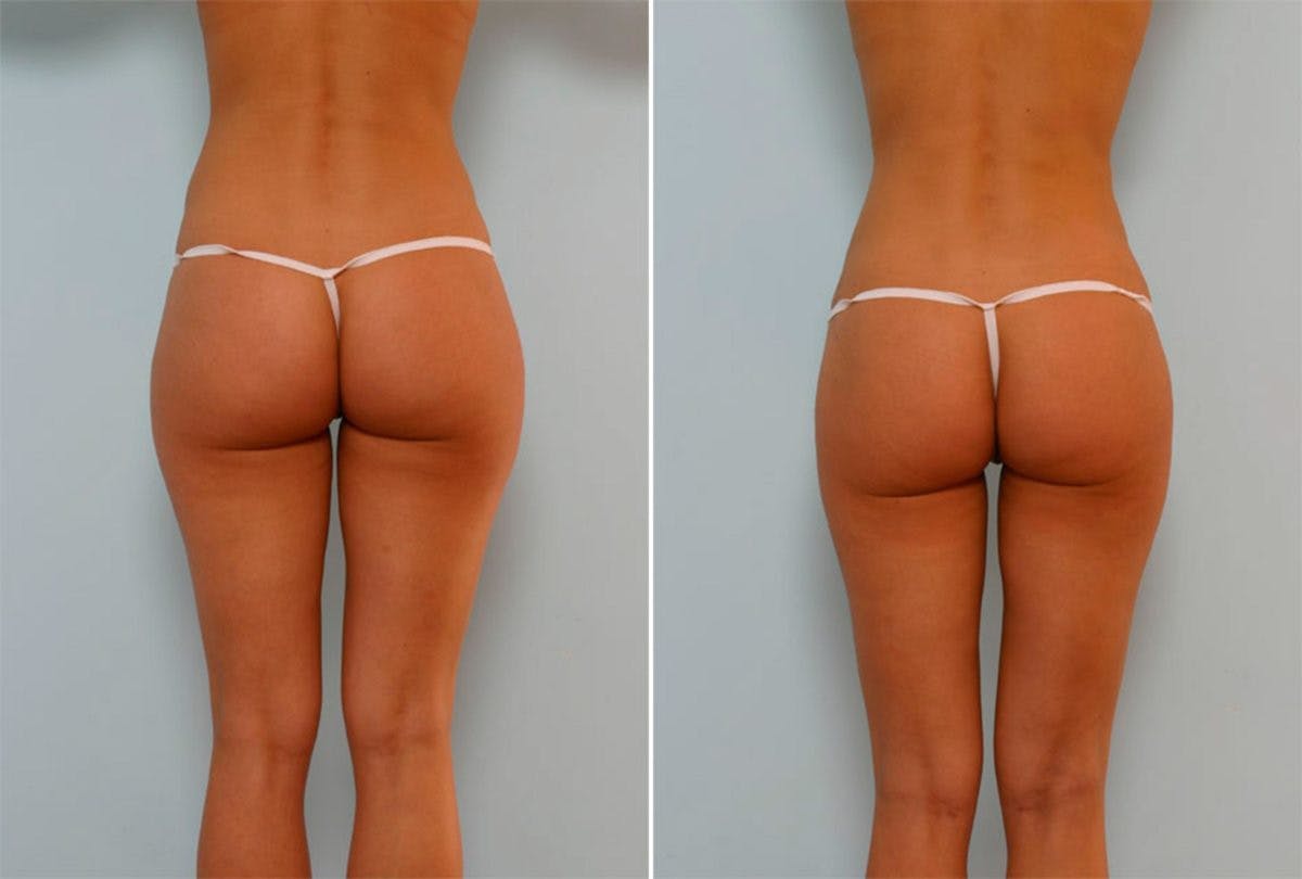Female Liposuction Before & After Photo - Patient 54867859 - Image 3