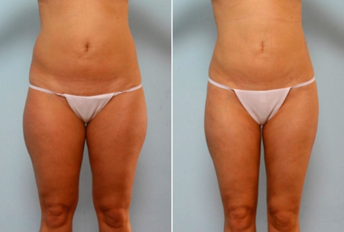 Female Liposuction Before & After Gallery - Patient 54867862 - Image 1