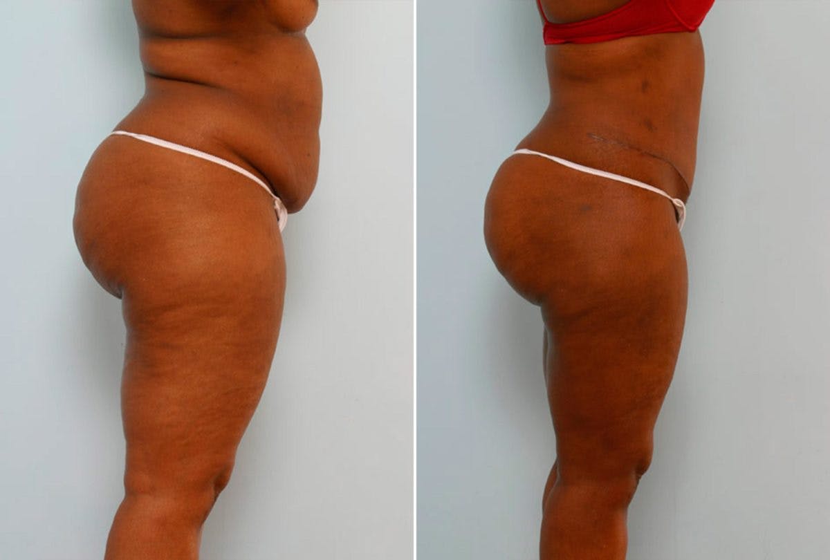 Abdominoplasty Before & After Gallery - Patient 54867861 - Image 3