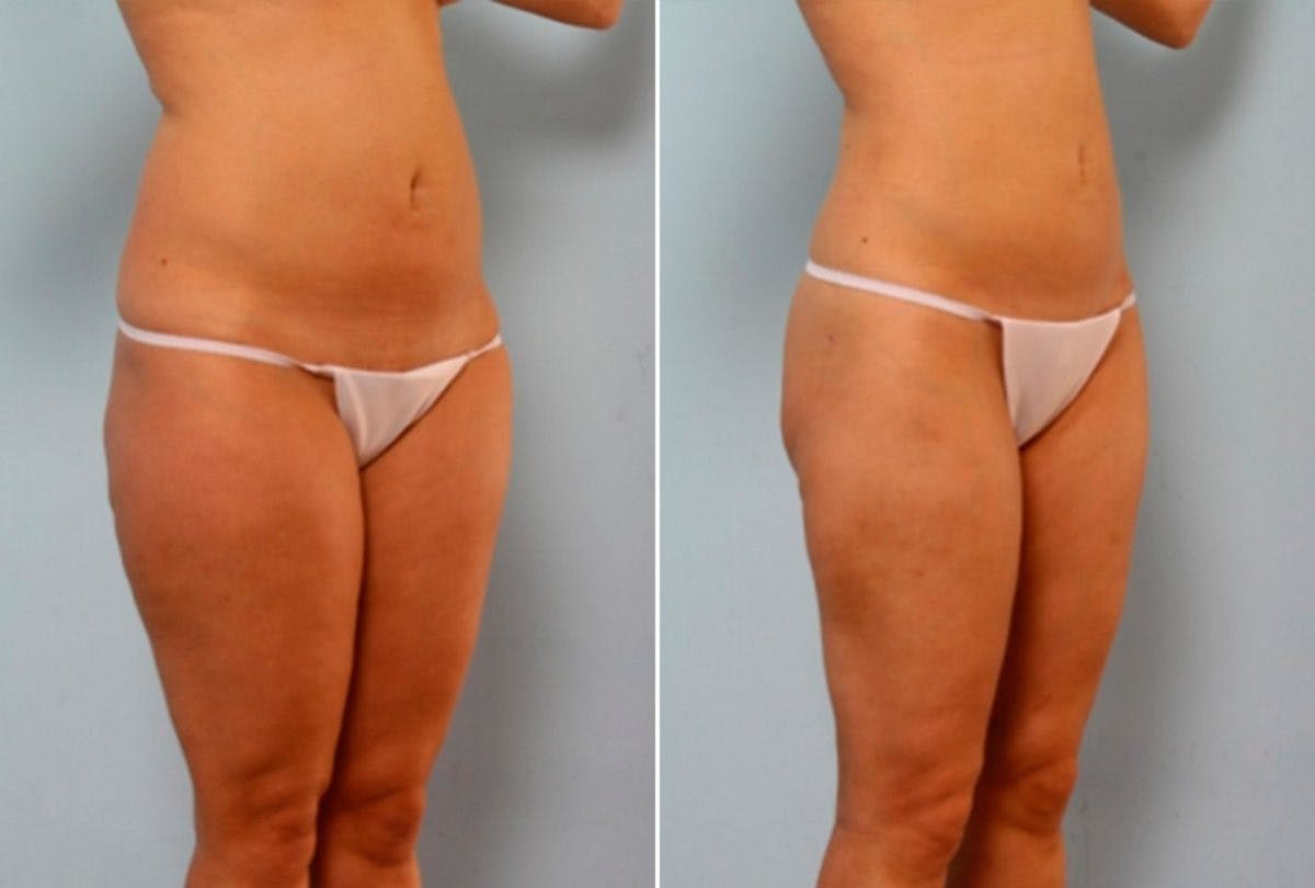 Female Liposuction Before & After Gallery - Patient 54867862 - Image 2