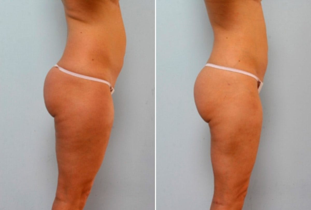 Female Liposuction Before & After Gallery - Patient 54867862 - Image 3