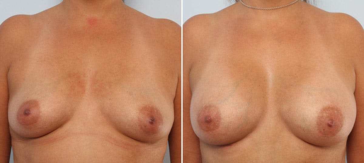 Mommy Makeover Before & After Photo - Patient 54867863 - Image 1