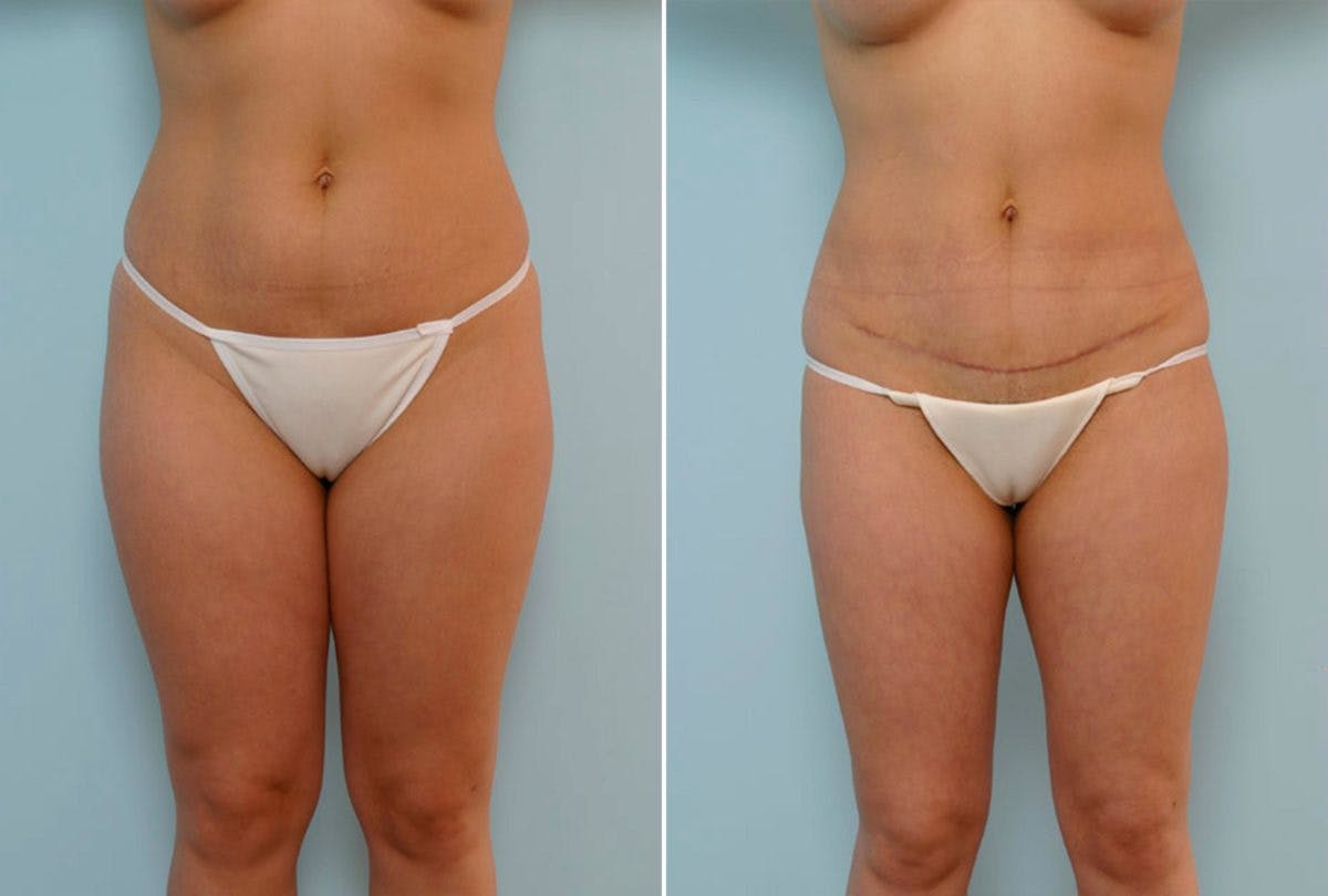 Abdominoplasty Before & After Gallery - Patient 54868613 - Image 1