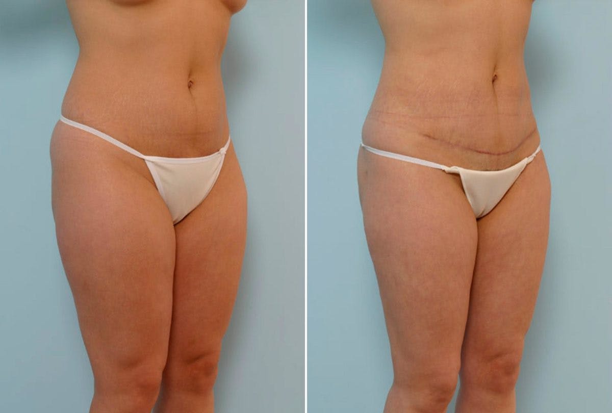 Abdominoplasty Before & After Gallery - Patient 54868613 - Image 2