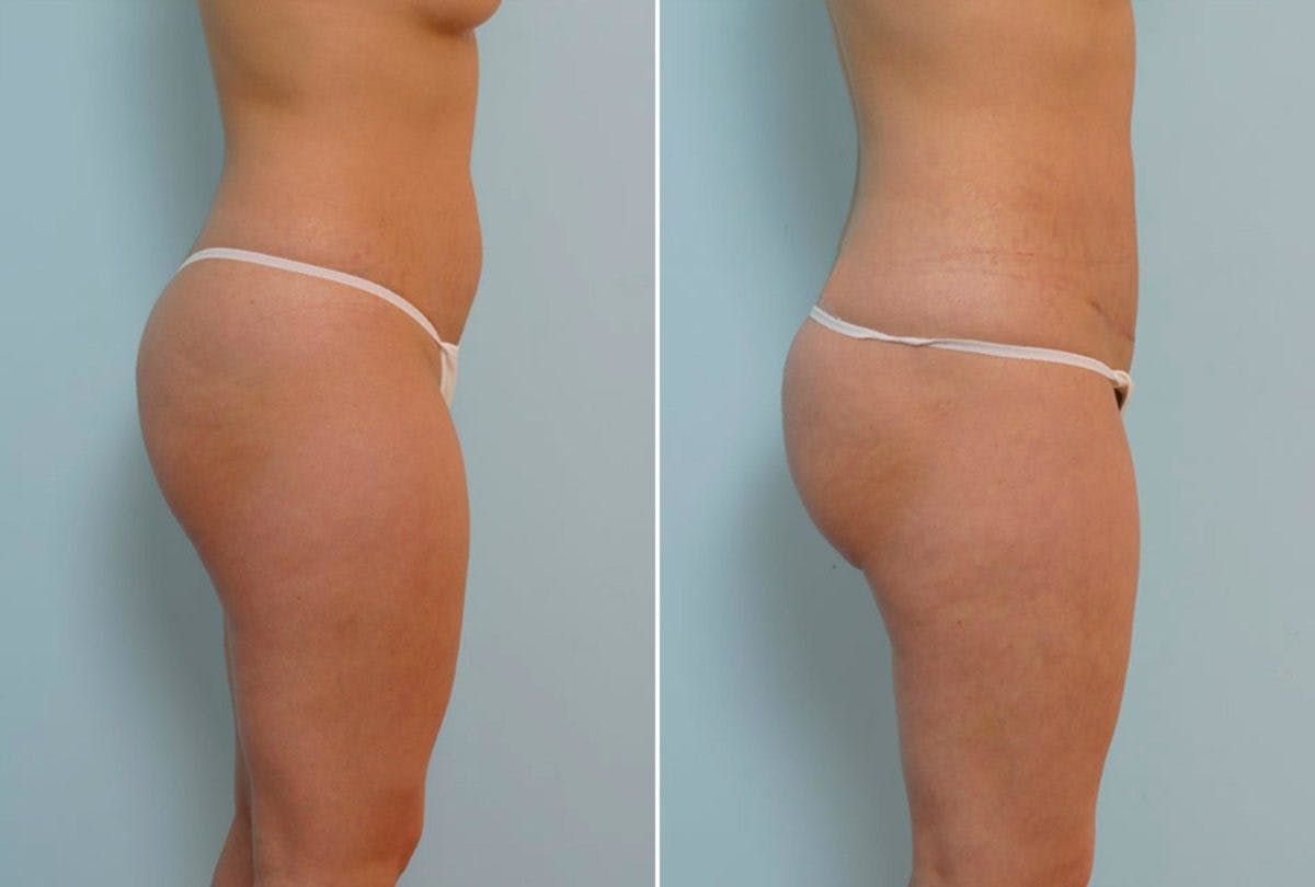 Abdominoplasty Before & After Gallery - Patient 54868613 - Image 3