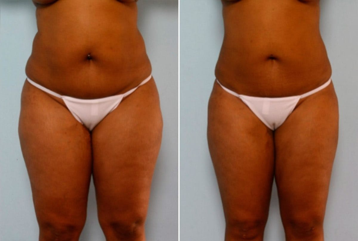 Female Liposuction Before & After Gallery - Patient 54868616 - Image 1
