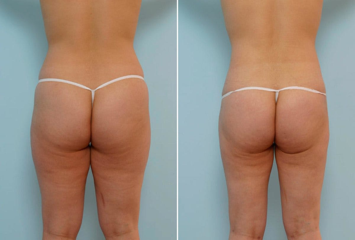 Abdominoplasty Before & After Gallery - Patient 54868613 - Image 4