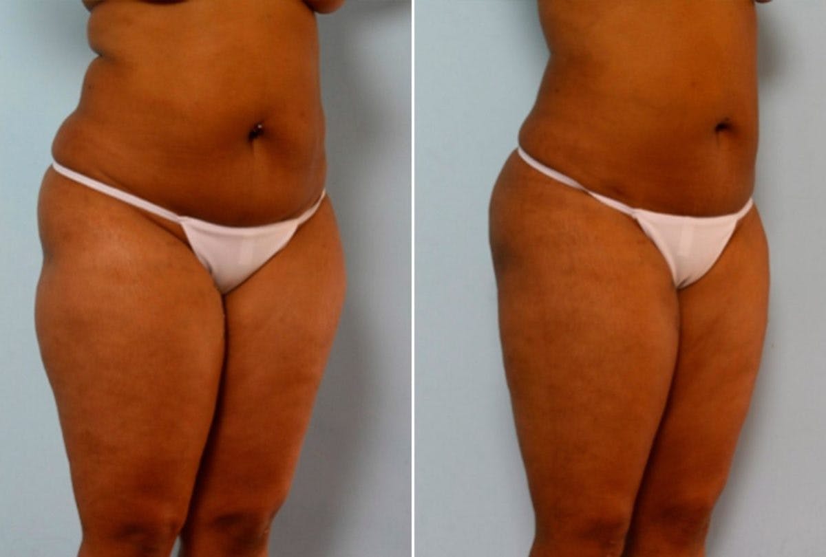 Female Liposuction Before & After Gallery - Patient 54868616 - Image 2