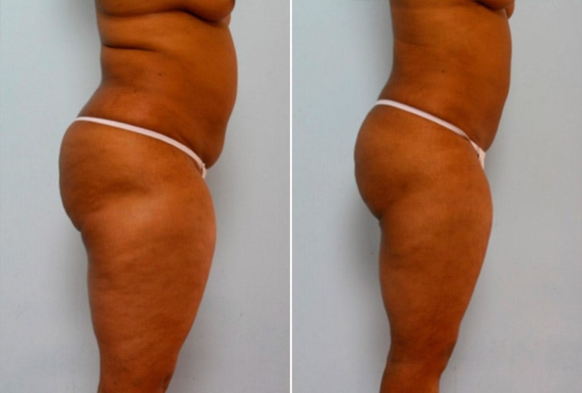 Female Liposuction Before & After Gallery - Patient 54868616 - Image 3