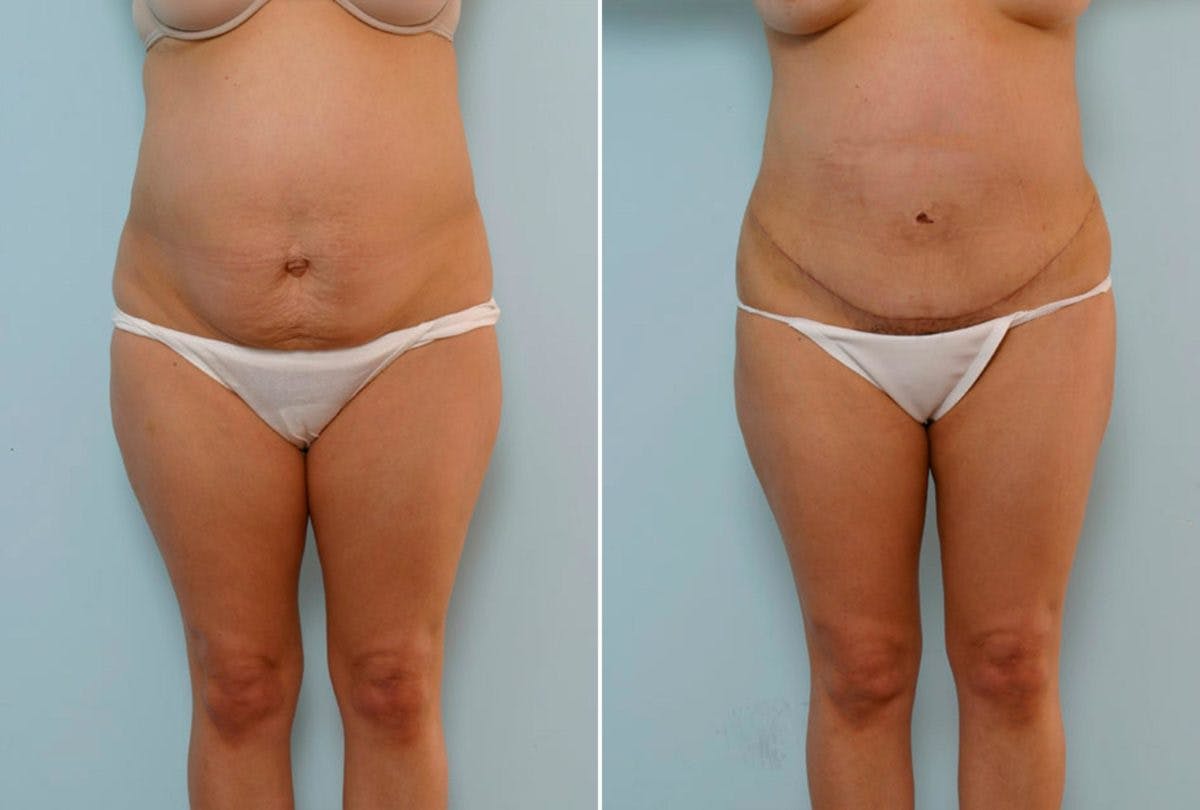 Abdominoplasty Before & After Gallery - Patient 54868614 - Image 1