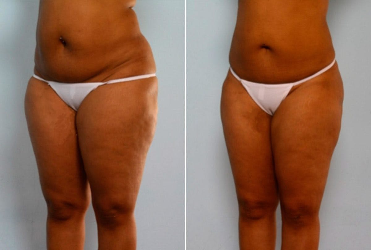 Female Liposuction Before & After Gallery - Patient 54868616 - Image 4