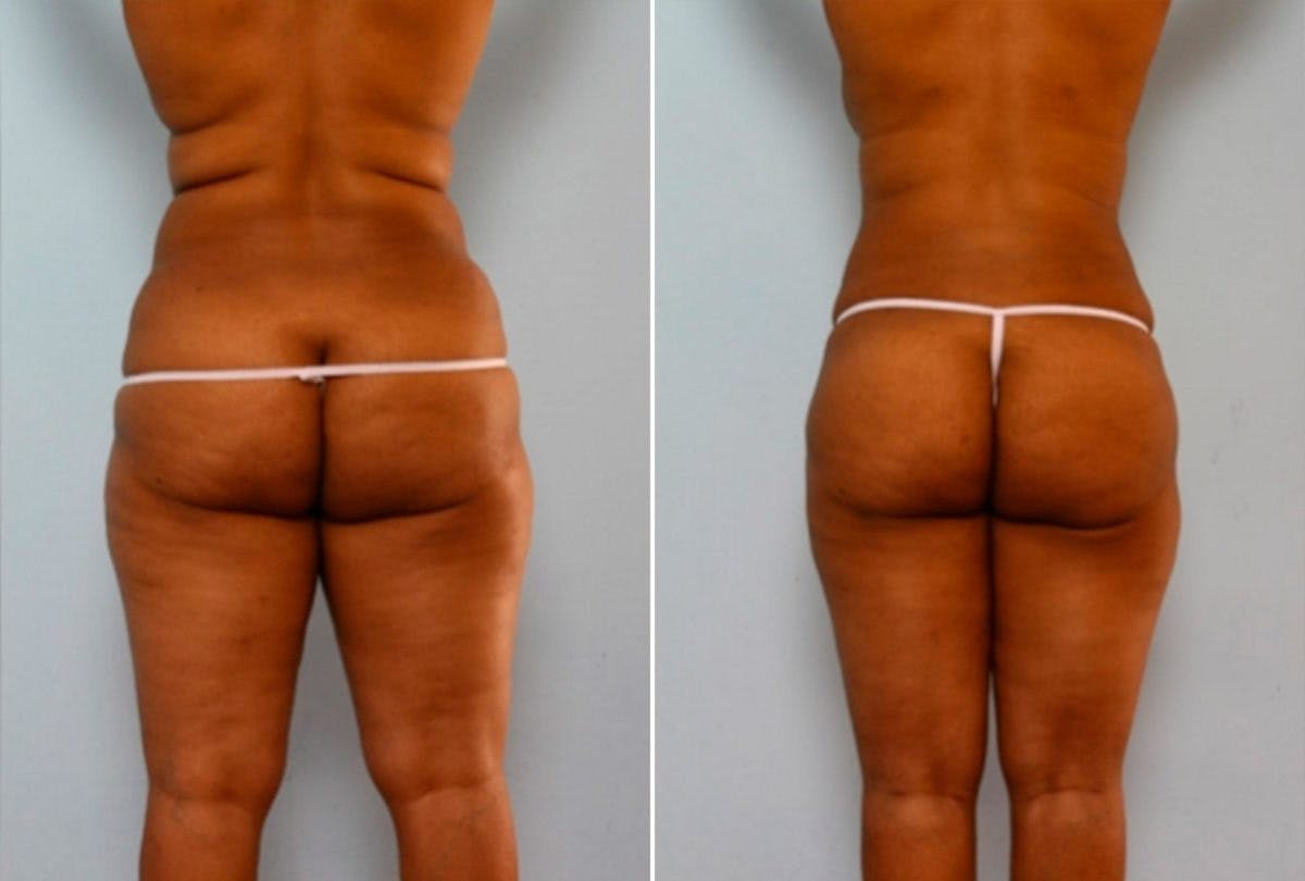 Female Liposuction Before & After Gallery - Patient 54868616 - Image 6