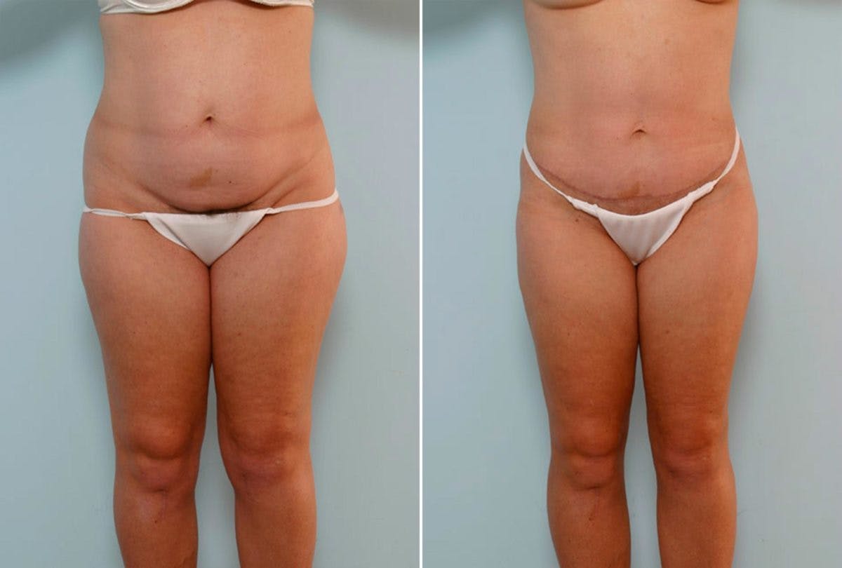 Abdominoplasty Before & After Gallery - Patient 54868622 - Image 1