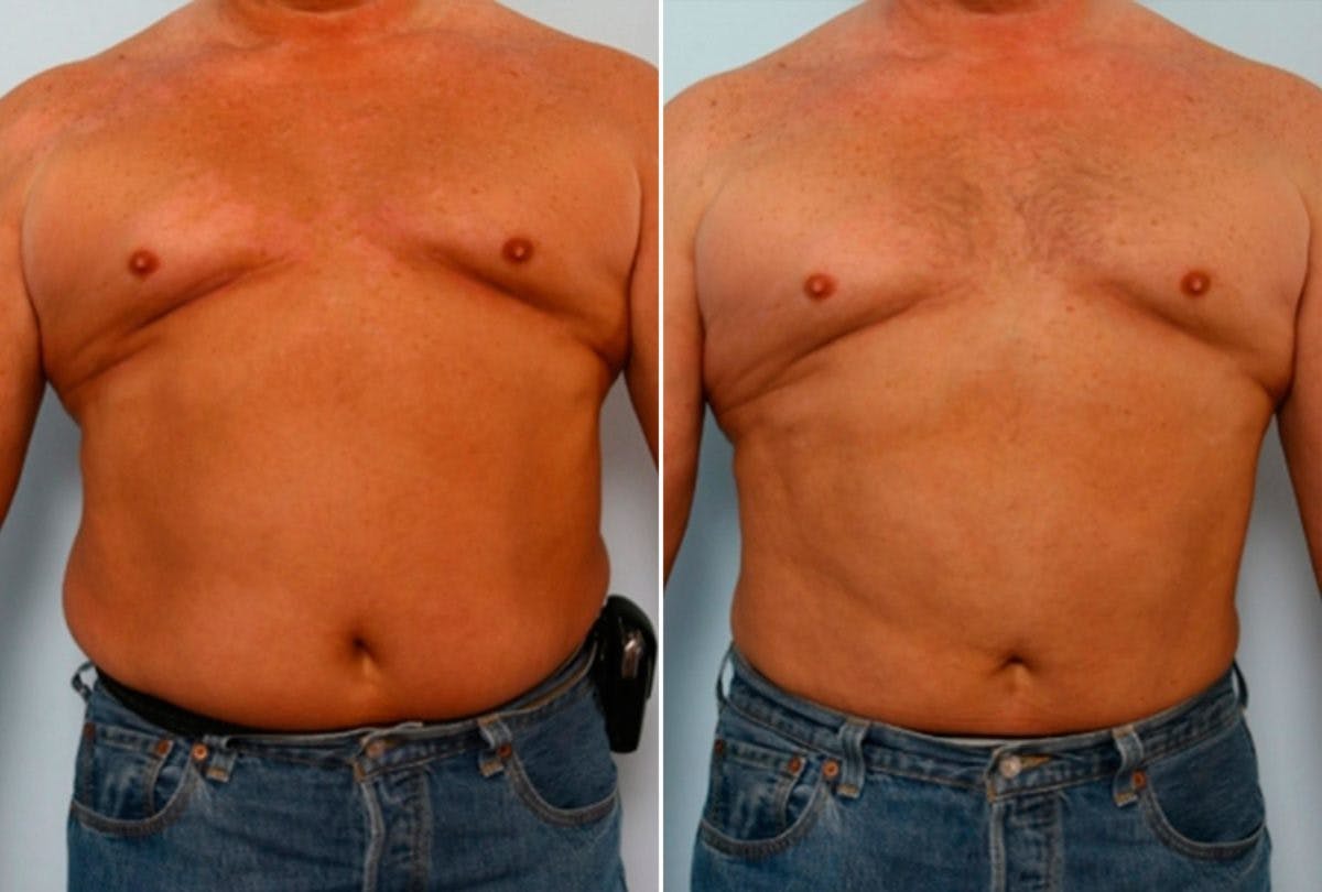 Male Liposuction Before & After Photo - Patient 55485538 - Image 1