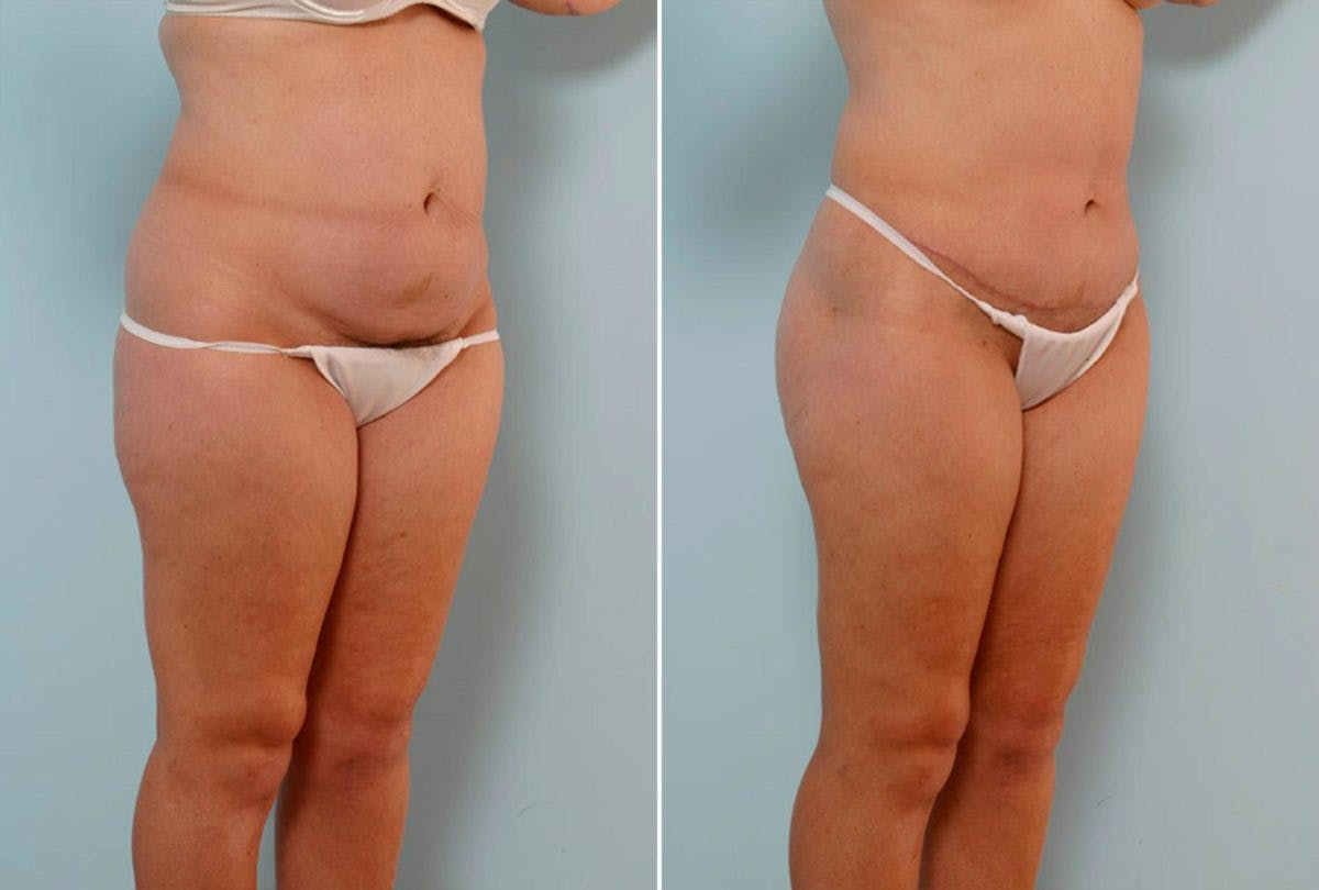 Abdominoplasty Before & After Gallery - Patient 54868622 - Image 2