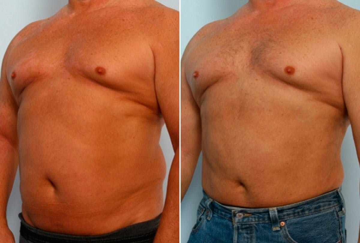 Male Liposuction Before & After Gallery - Patient 55485538 - Image 2
