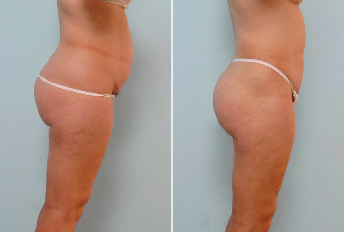 Abdominoplasty Before & After Gallery - Patient 54868622 - Image 3